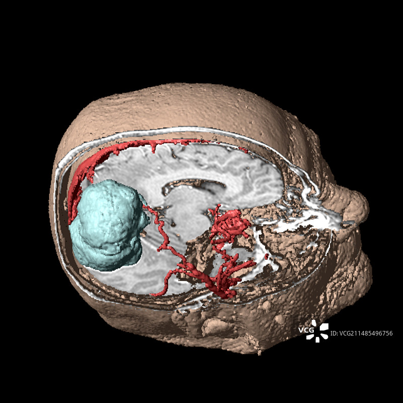 脑肿瘤3D扫描图片素材