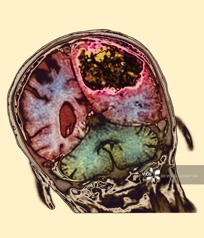 脑肿瘤图片素材
