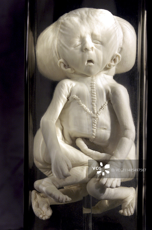 连体双胞胎图片素材