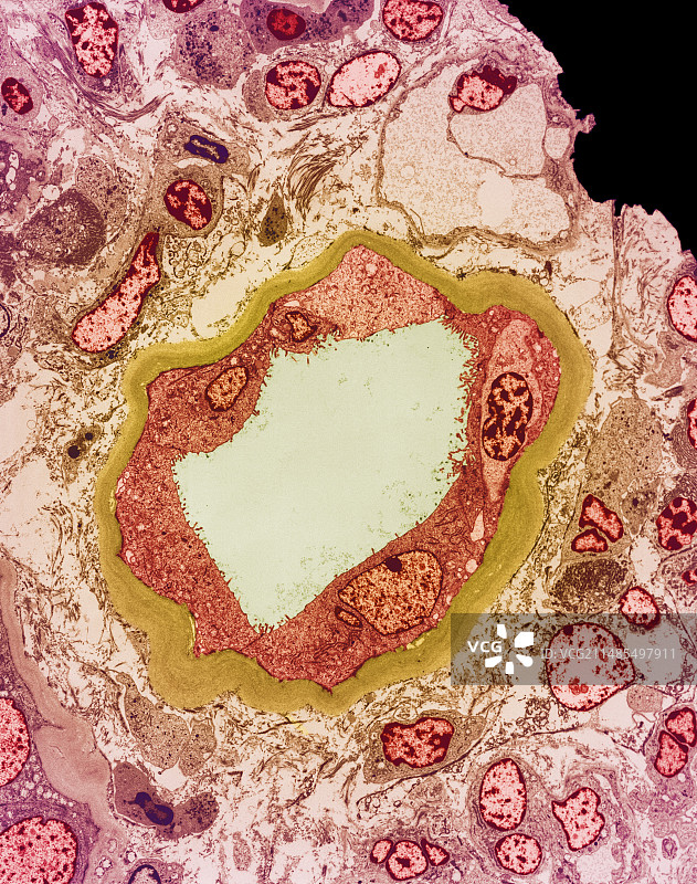 肾积水图片素材