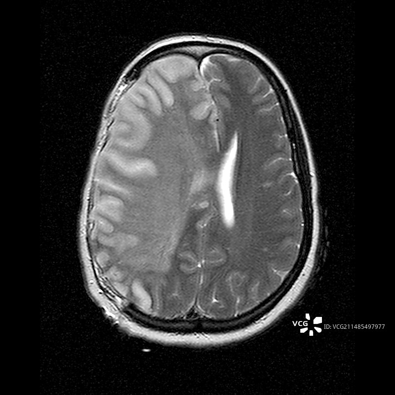 中风核磁共振扫描图片素材