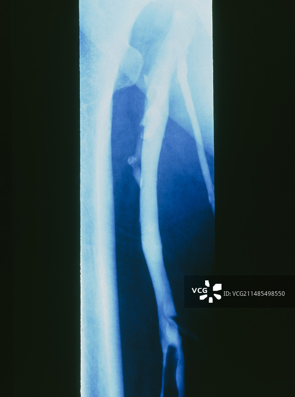 腿部静脉血栓性静脉炎图片素材