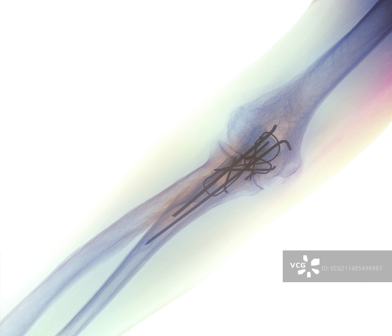 肘部骨折X光片图片素材