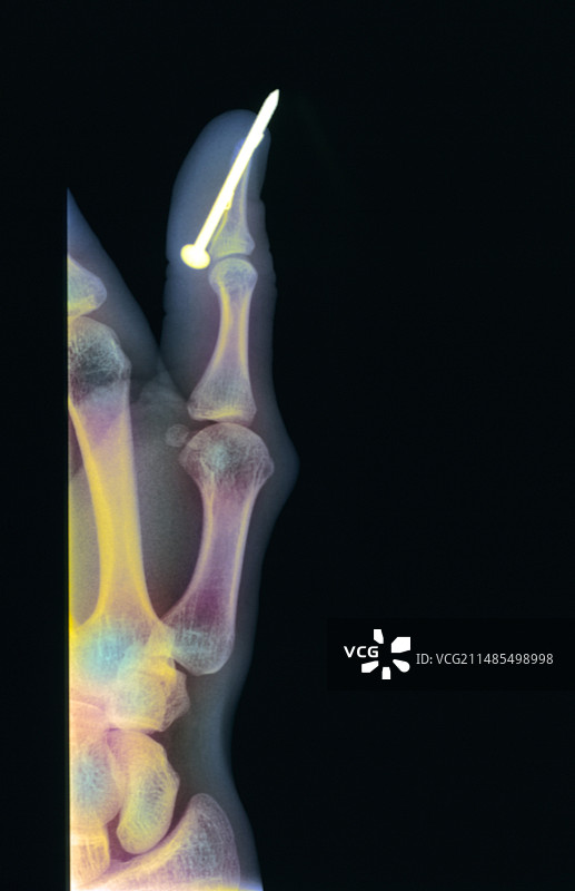 拇指X光片中的钉子图片素材