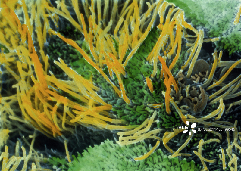 子宫增生图片素材