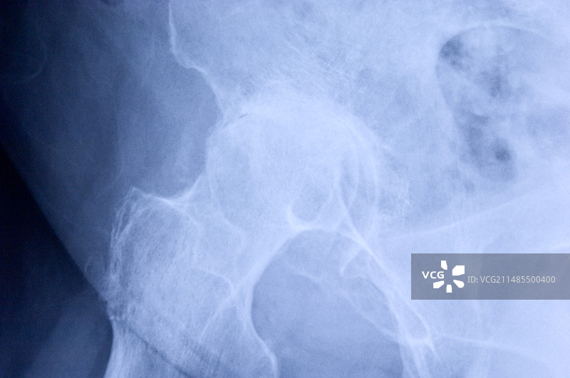 髋关节骨关节炎X光片图片素材