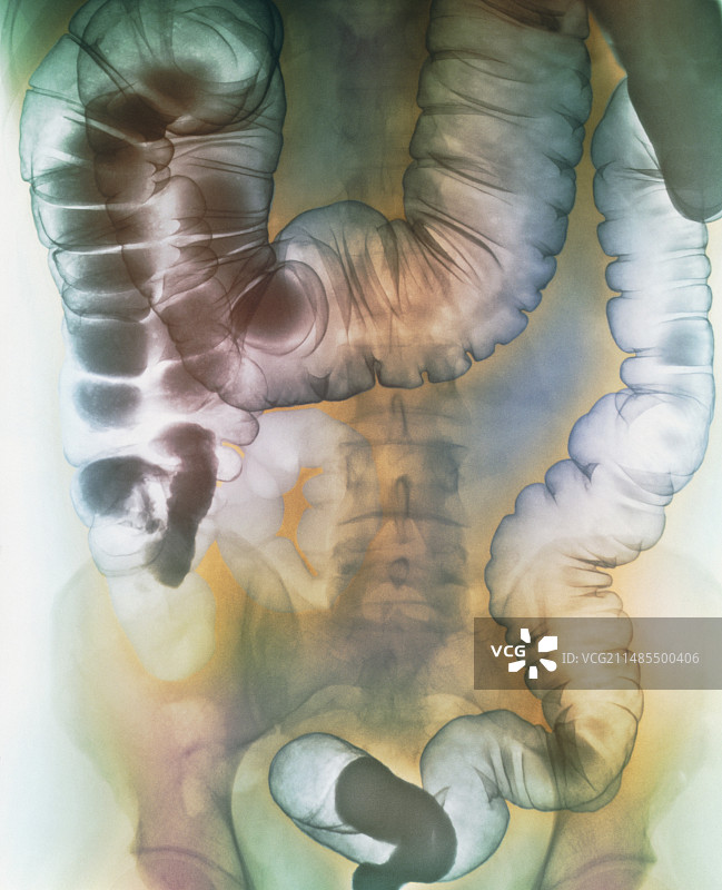 显示直肠炎的腹部彩色X光片图片素材