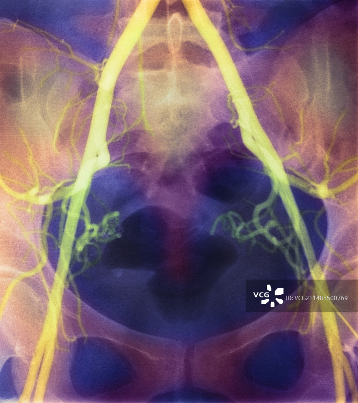 彩色X射线骨盆髂动脉图图片素材