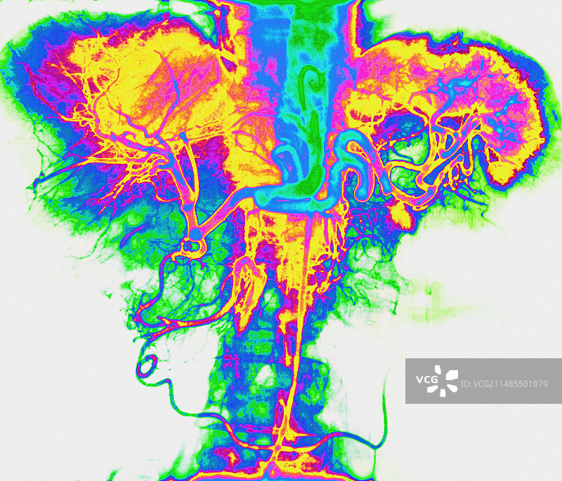 动脉的X光片图片素材