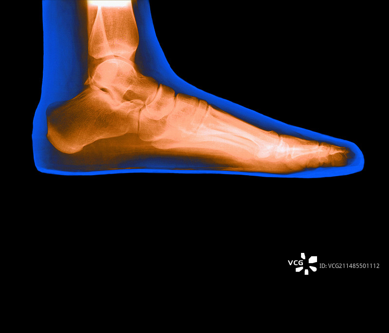 女性扁平足的彩色X光片图片素材