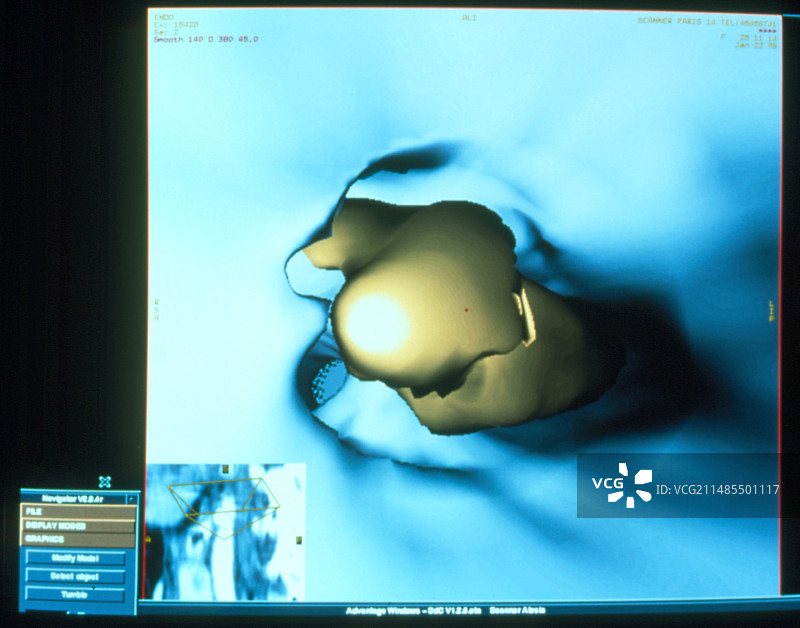 颈动脉阻塞的3D CT扫描图片素材