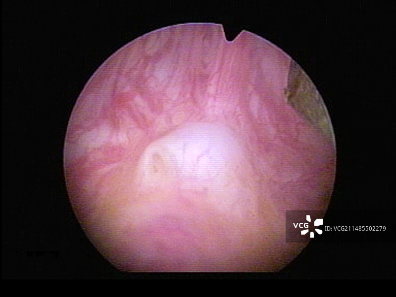 男性尿道内窥镜图像图片素材
