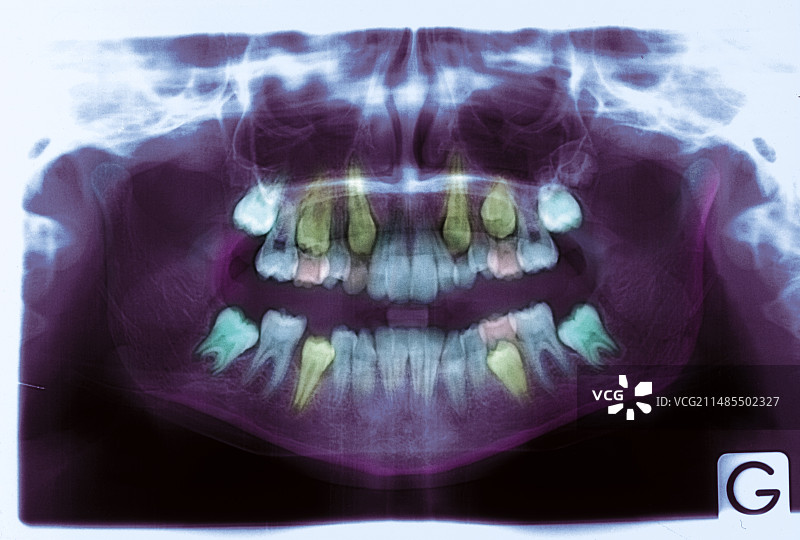 成人牙齿的萌出，X光片图片素材