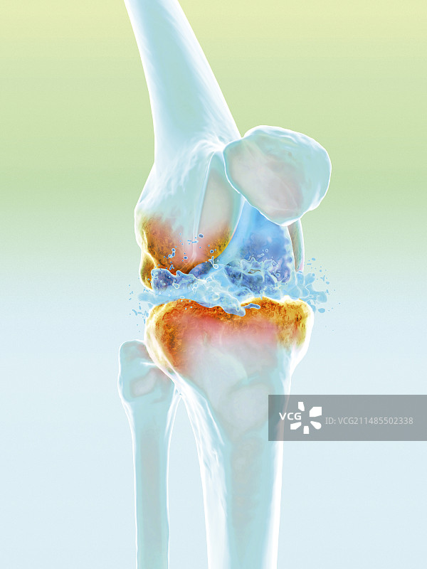 关节炎治疗图片素材