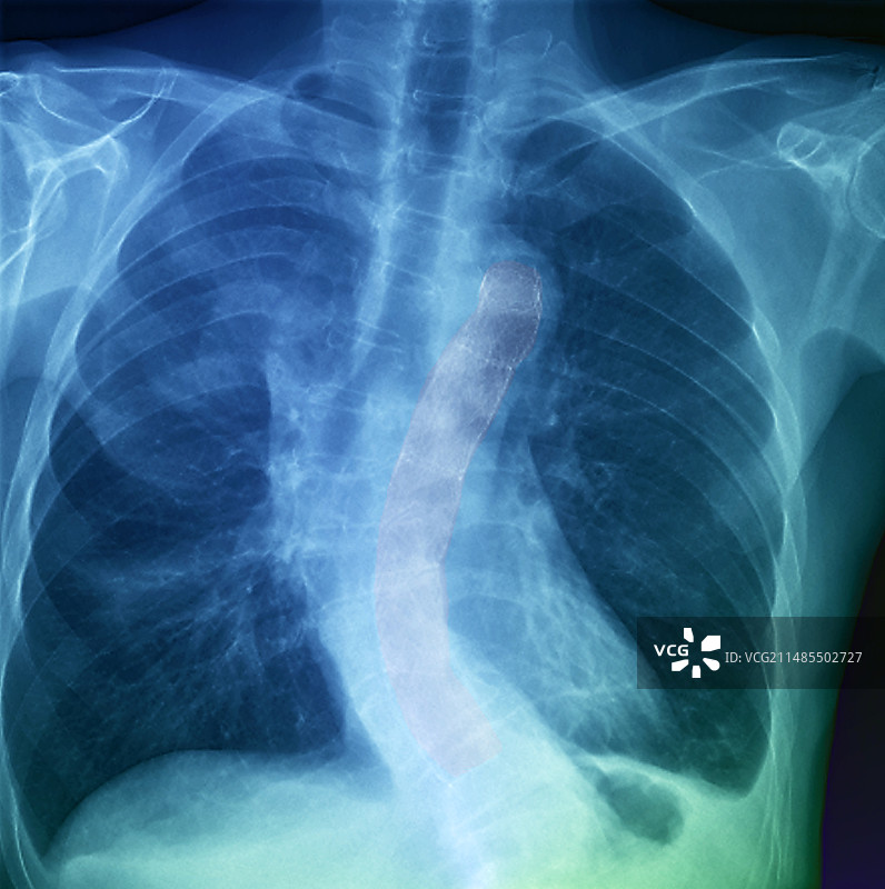 胸主动脉支架血管造影图片素材