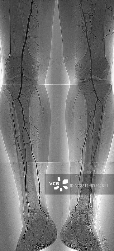 腿部动脉狭窄血管造影图片素材