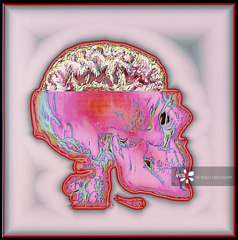 彩色3D脑部MRI扫描图（CT扫描头骨）图片素材