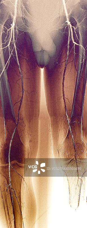 腿部动脉狭窄血管造影图片素材