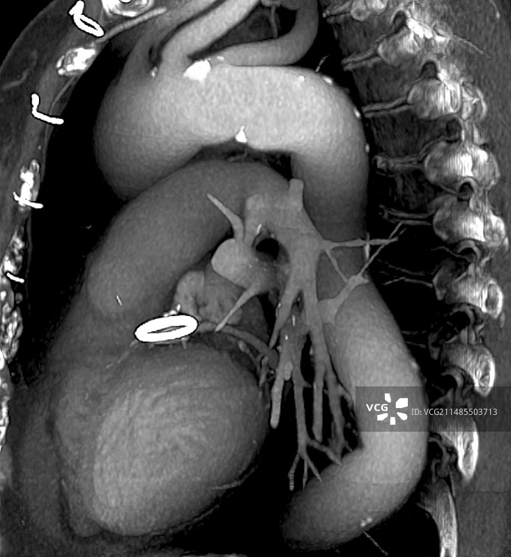 人工心脏瓣膜3D CT扫描图片素材