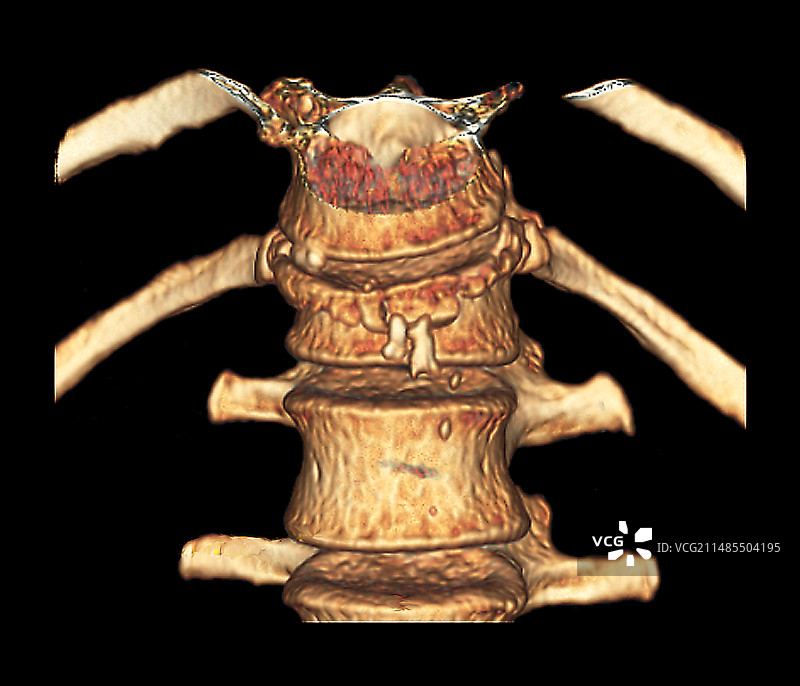 骨质疏松性脊柱骨折3D CT扫描图片素材