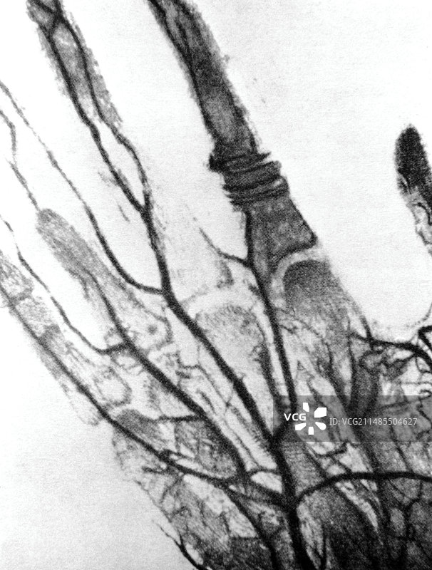 手部血管的首次血管造影图片素材