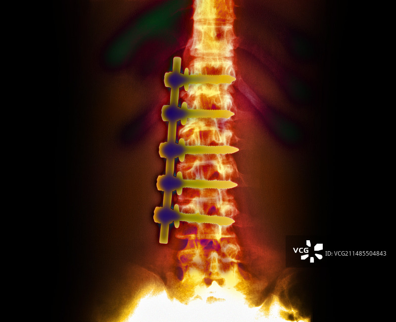 脊柱侧弯矫正X光片图片素材