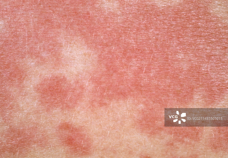 手臂食物过敏皮疹图片素材