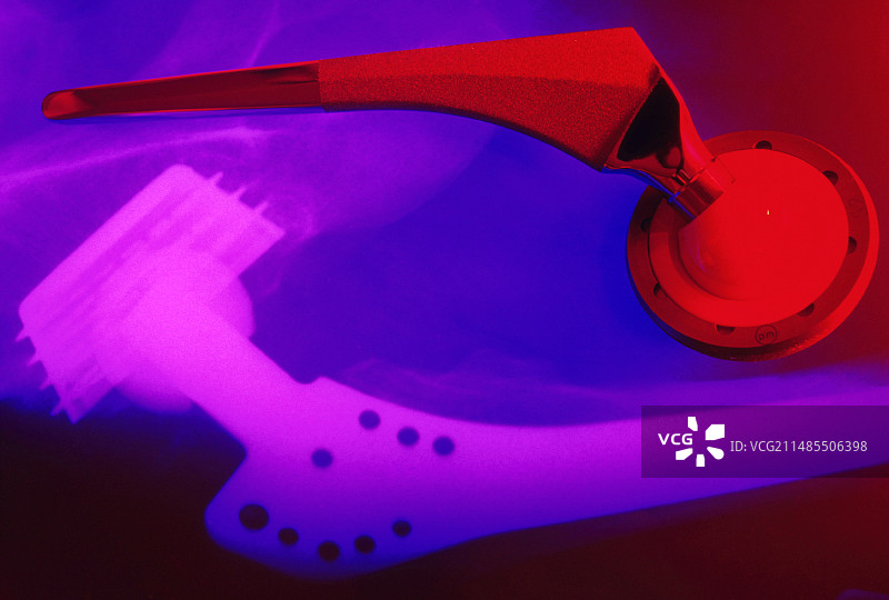 人工髋关节X光片与假体图片素材