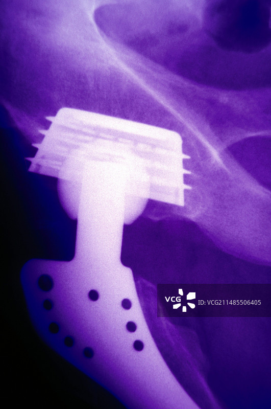 人工髋关节X光片图片素材