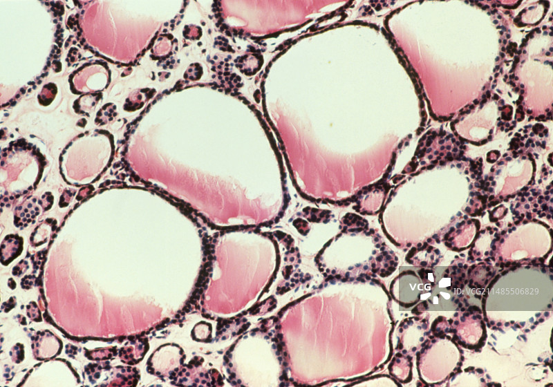 甲状腺肿大滤泡的LM显微图图片素材