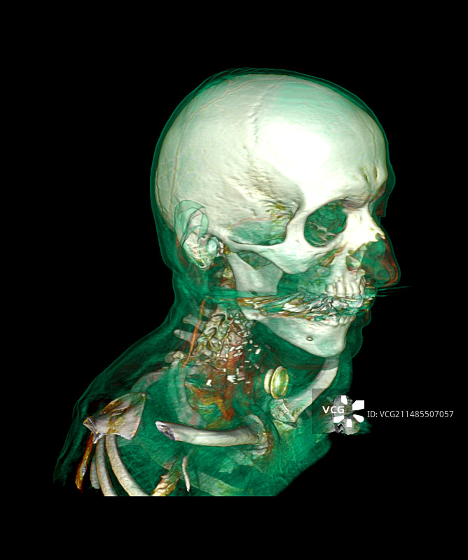 气管切开术CT扫描图片素材