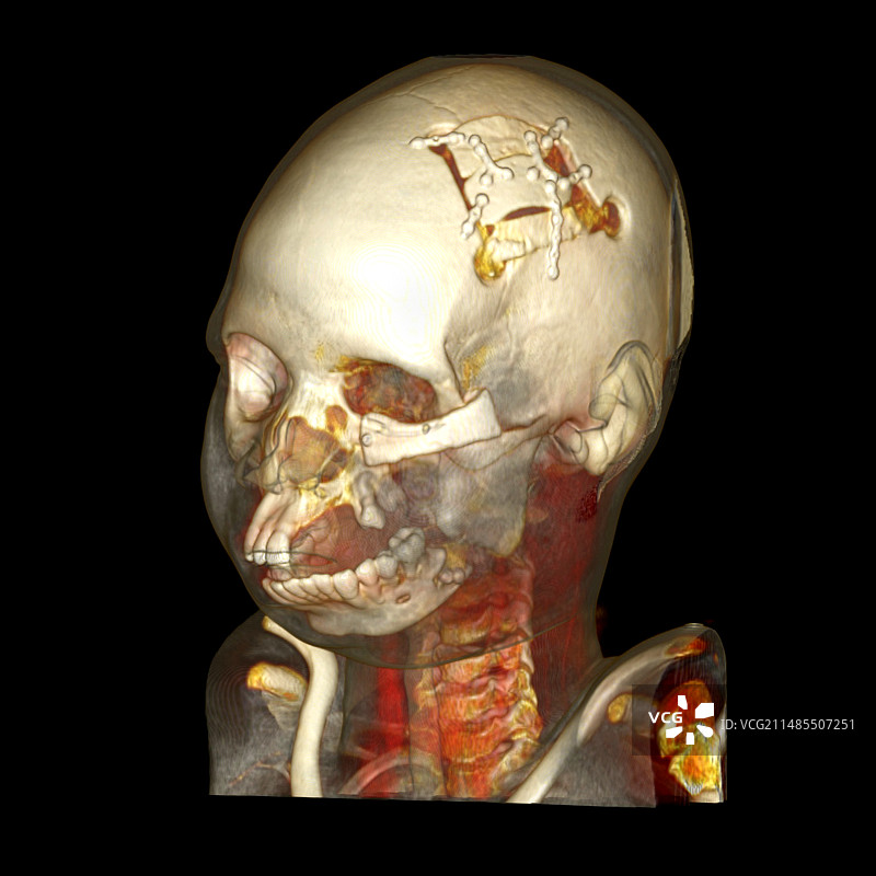 面部重建，CT扫描图片素材