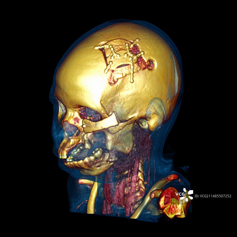 面部重建，CT扫描图片素材