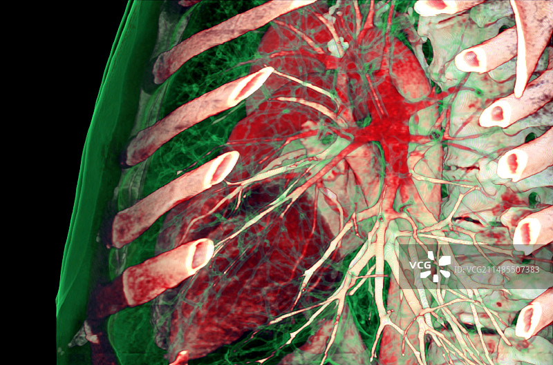 胸部CT扫描图片素材