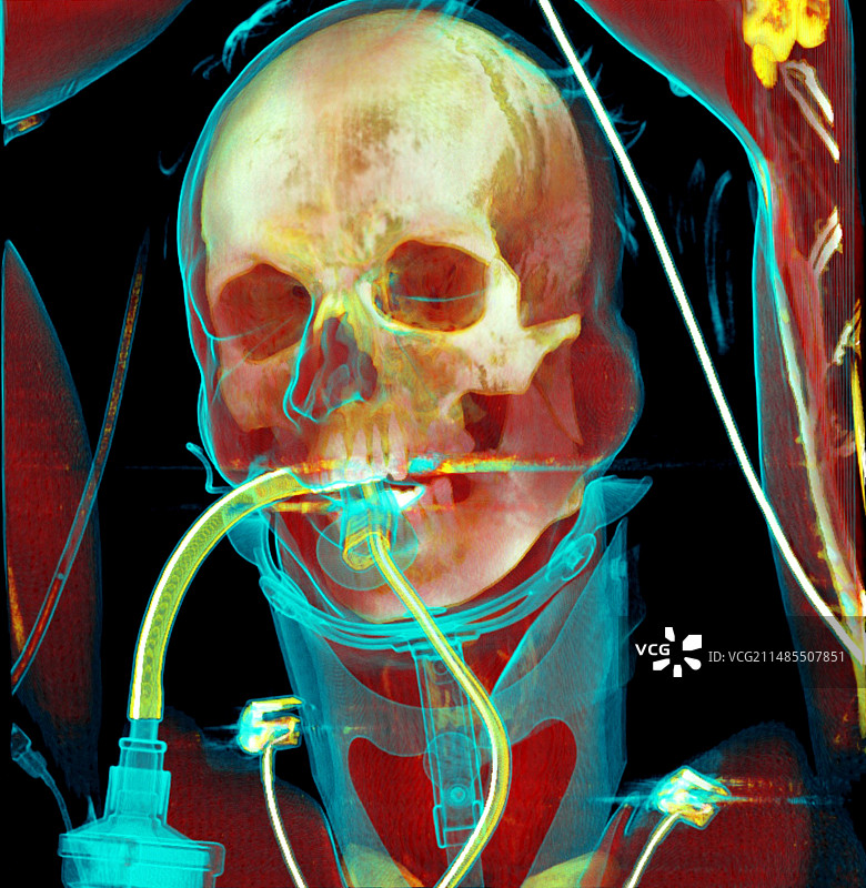 重症监护患者的CT扫描图片素材