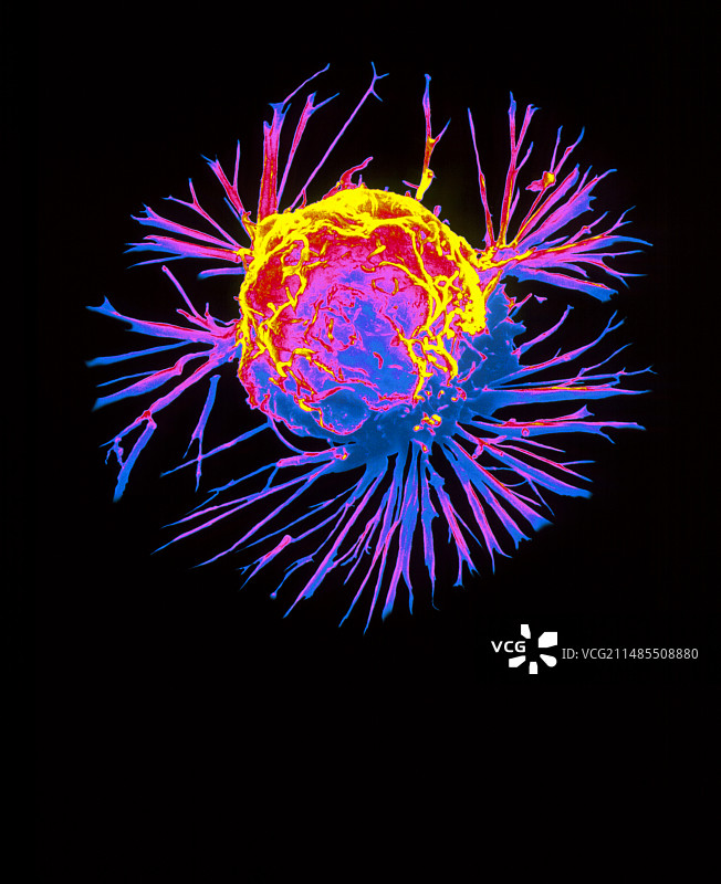 乳腺癌细胞的彩色扫描电镜图像图片素材