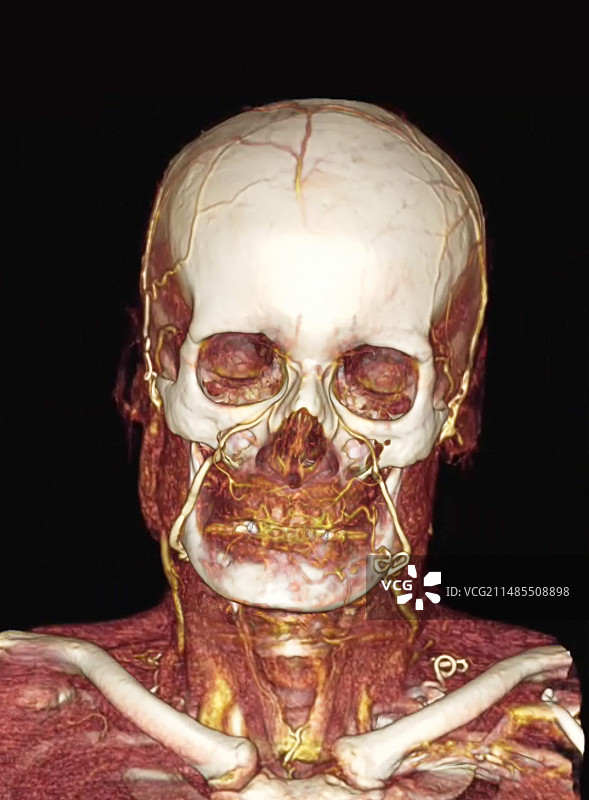 头部和颈部的CT扫描图片素材