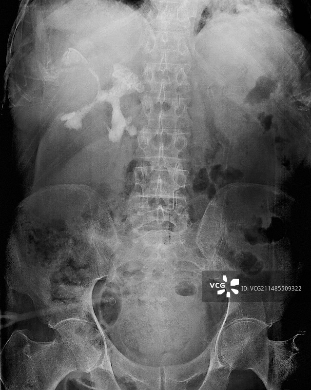 鹿角形肾结石X光片图片素材