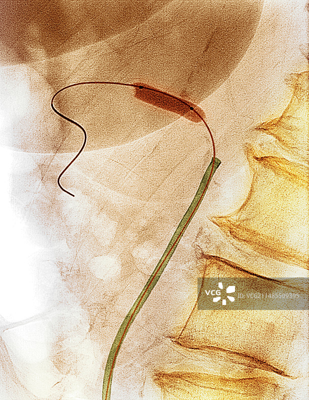 球囊血管成形术X光片图片素材