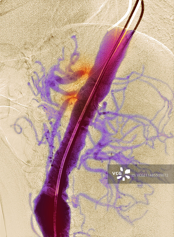 动脉狭窄X光片图片素材