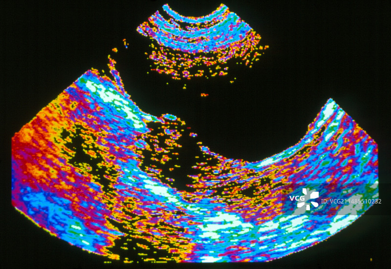 子宫肌瘤的彩色超声波扫描图片素材