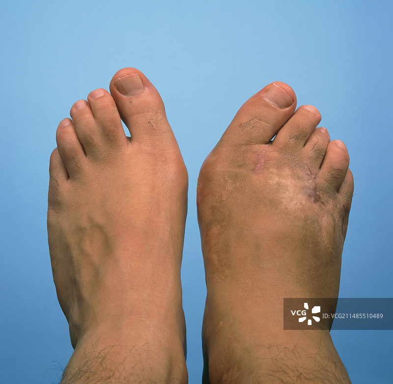 男人脚上的拇囊炎图片素材