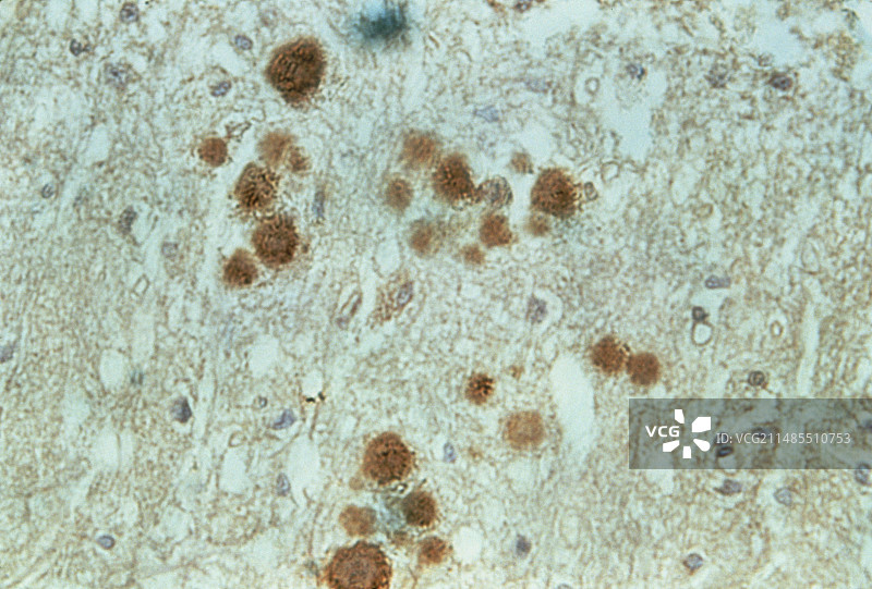 大脑Gertsmann-Straussler-Scheinker综合征的光学显微镜图片素材