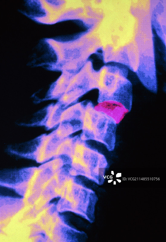 颈椎植入椎间盘的彩色X光片图片素材