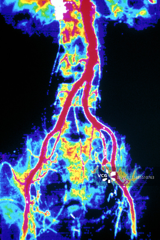 正常主动脉的彩色血管造影图片素材