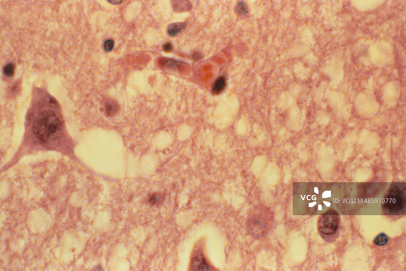 克雅氏病人脑组织光学显微镜图图片素材
