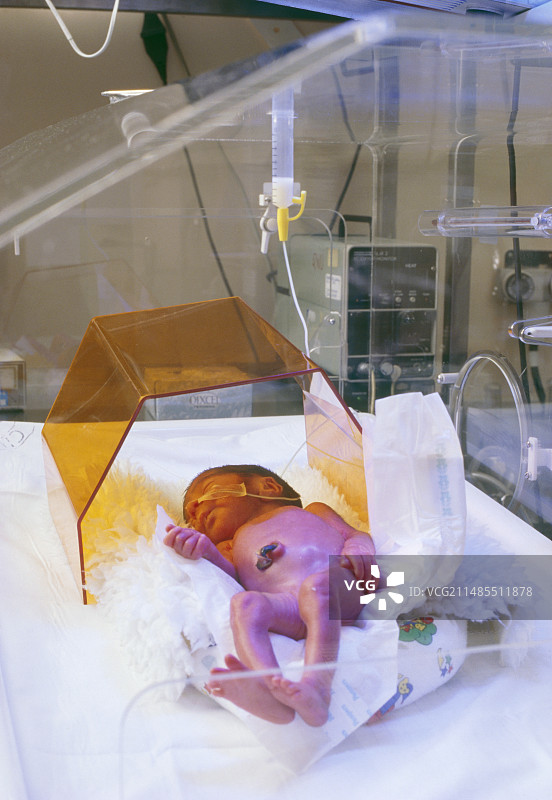 新生儿黄疸治疗图片素材