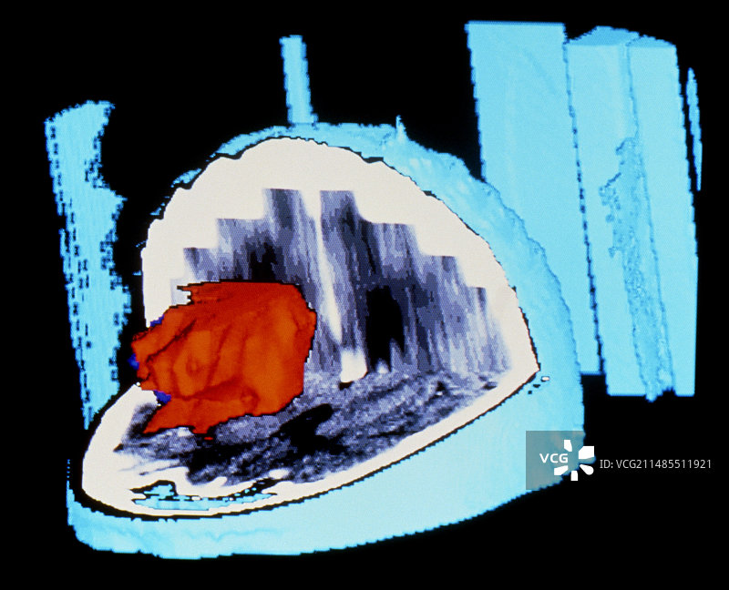 神经胶质母细胞瘤脑肿瘤的彩色3D CT扫描图片素材