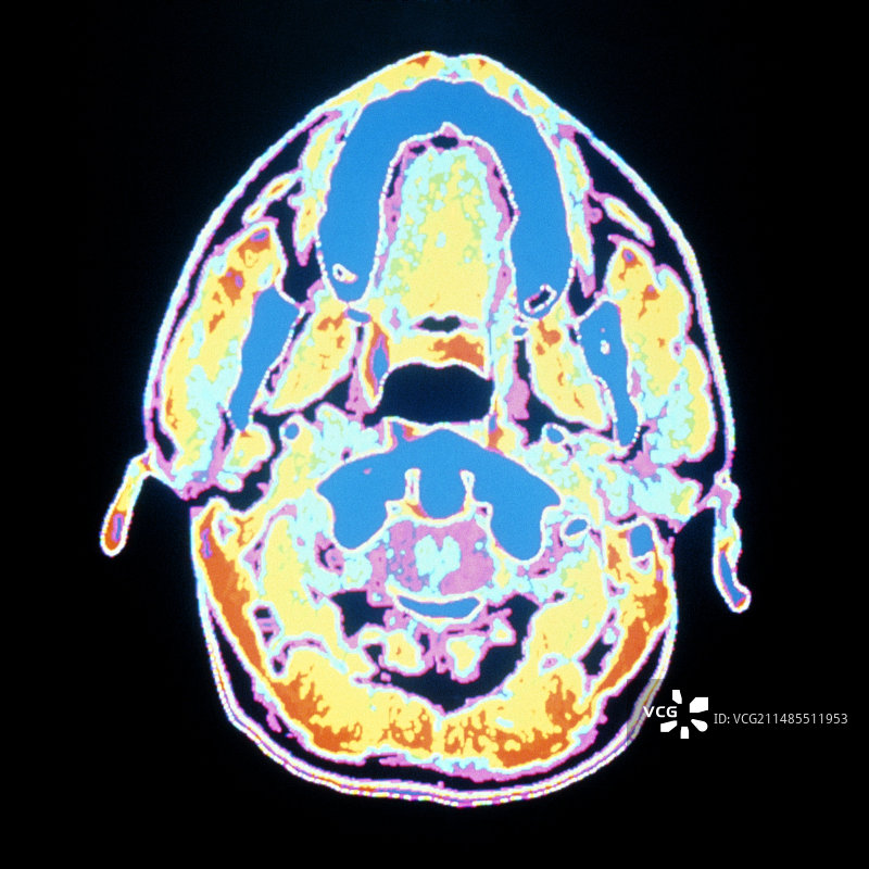 口腔和咽喉的计算机断层扫描图片素材