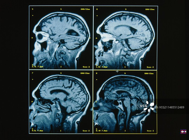 大脑的四个MRI扫描侧视图图片素材